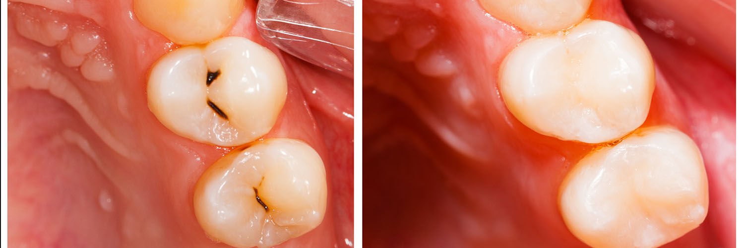 Dental bridge