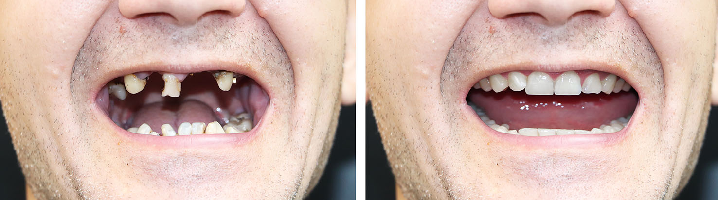 All-on-4 dental implants